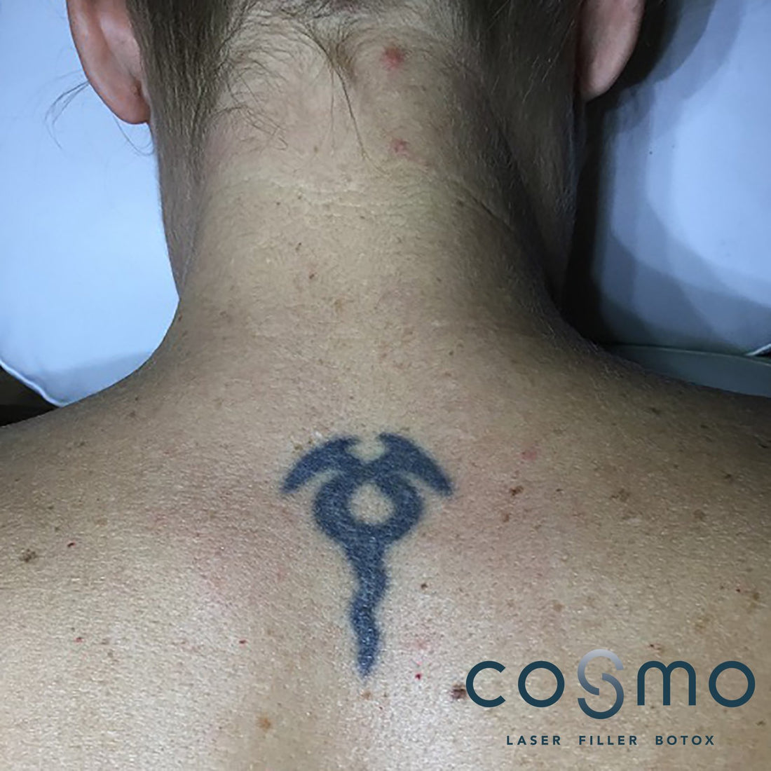 Alt om tatoveringsfjernelse - Cosmo Laser