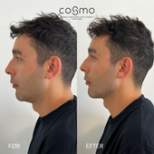 Hvordan får mænd naturlige og maskuline resultater med filler?