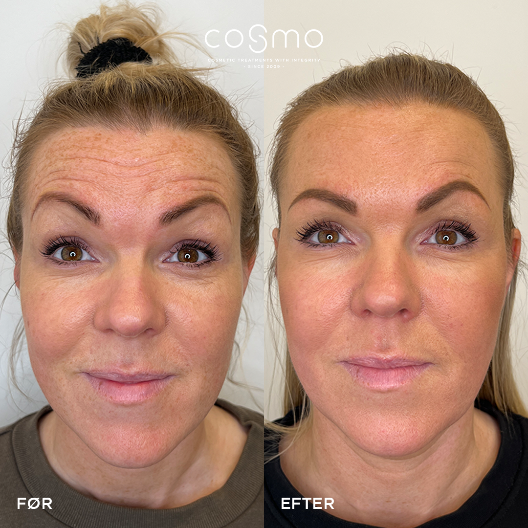Før/efter laserbehandling hos Cosmo Laser. Synligt reduceret rynker og finere hudtone. Før/efter laserbehandling hos Cosmo Laser. Synligt reduceret rynker og finere hudtone.