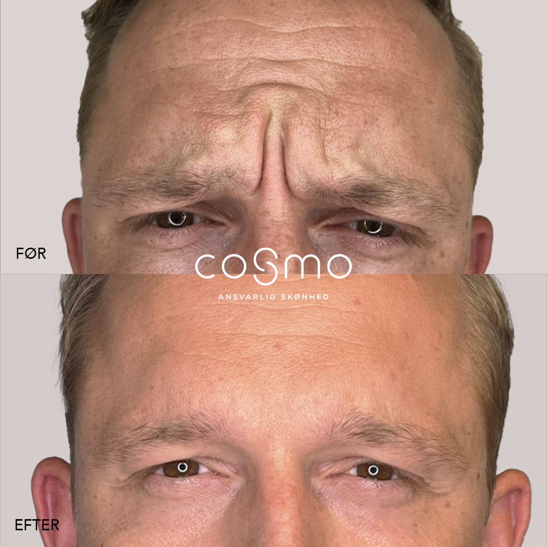 Før/efter billeder af botoxbehandling mod bekymringsrynker. Resultat fra Cosmo Laser. Før/efter billeder af botoxbehandling mod bekymringsrynker. Resultat fra Cosmo Laser.