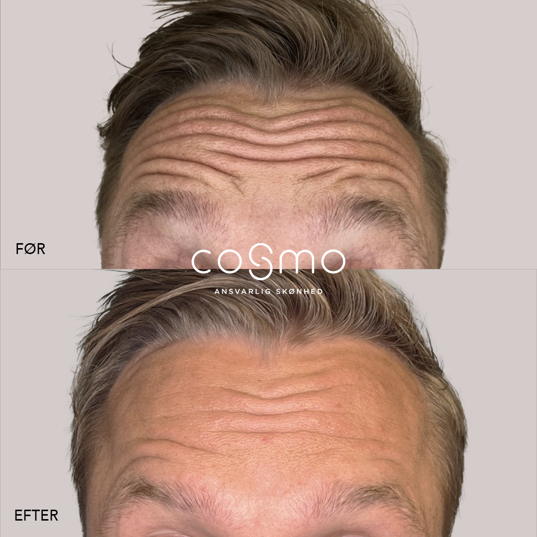 Før/efter billede: Botoxbehandling af panderynker hos mand. Resultater fra Cosmo Laser. Før/efter billede: Botoxbehandling af panderynker hos mand. Resultater fra Cosmo Laser.