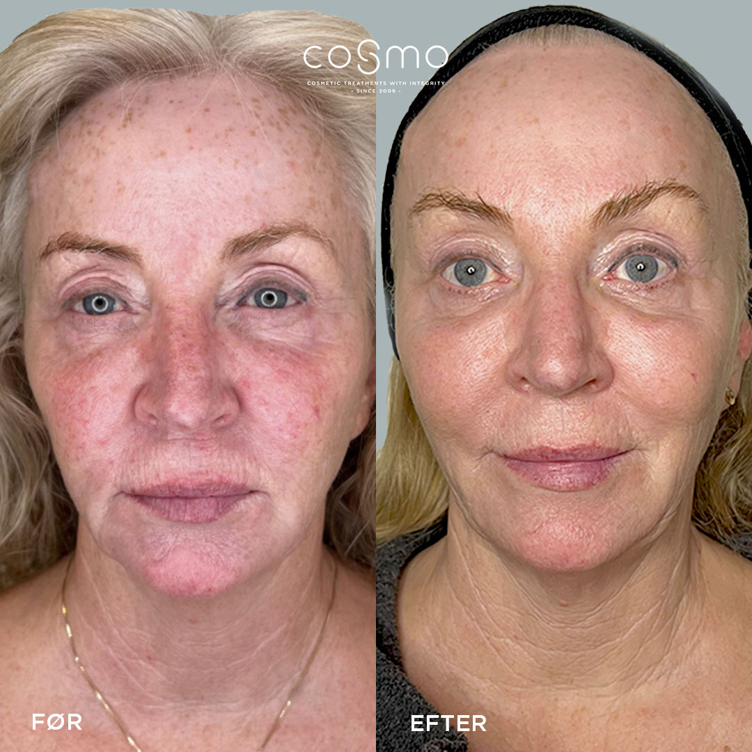 Før/efter IPL & Frax laserbehandling hos Cosmo Laser. Rødme og rynker reduceres synligt efter 3 behandlinger. Før/efter IPL & Frax laserbehandling hos Cosmo Laser. Rødme og rynker reduceres synligt efter 3 behandlinger.