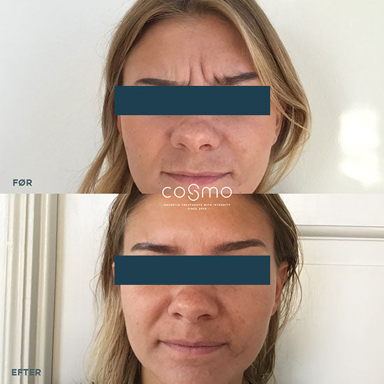 Før/efter billeder af botoxbehandling mod bekymringsrynker. Resultater fra Cosmo Laser. Før/efter billeder af botoxbehandling mod bekymringsrynker. Resultater fra Cosmo Laser.