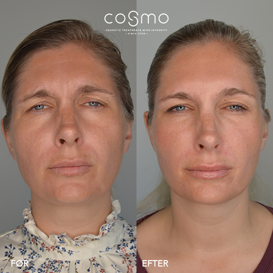 Før/efter billeder af botoxbehandling mod bekymringsrynker. Resultater fra Cosmo Laser. Før/efter billeder af botoxbehandling mod bekymringsrynker. Resultater fra Cosmo Laser.