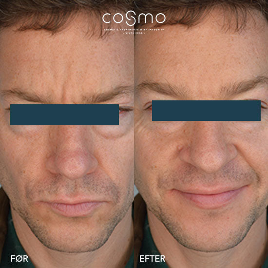 Før/efter billeder af botoxbehandling mod bekymringsrynker. Resultater fra Cosmo Laser. Før/efter billeder af botoxbehandling mod bekymringsrynker. Resultater fra Cosmo Laser.