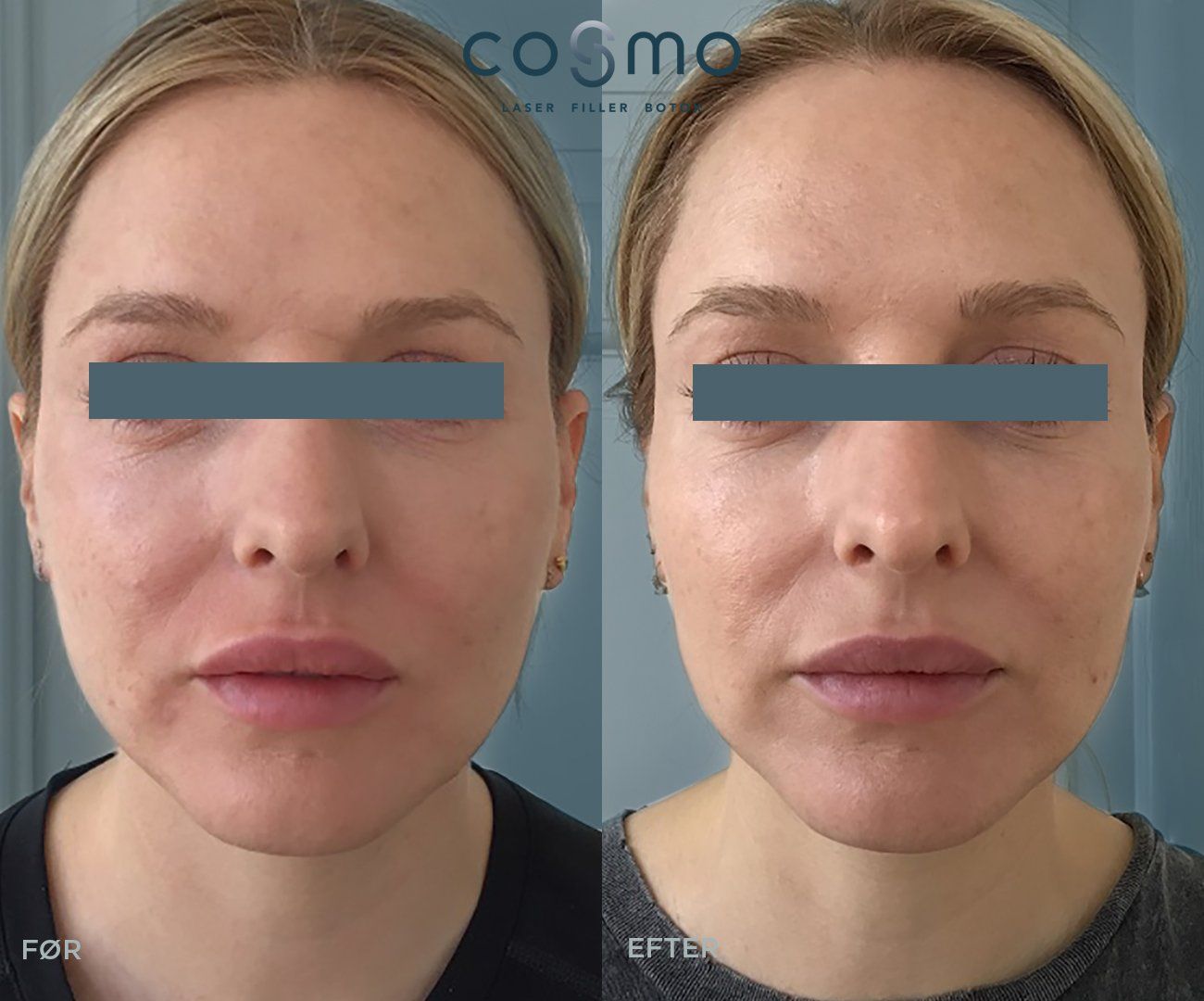 Før og efter Botox-behandling. Før og efter Botox-behandling.