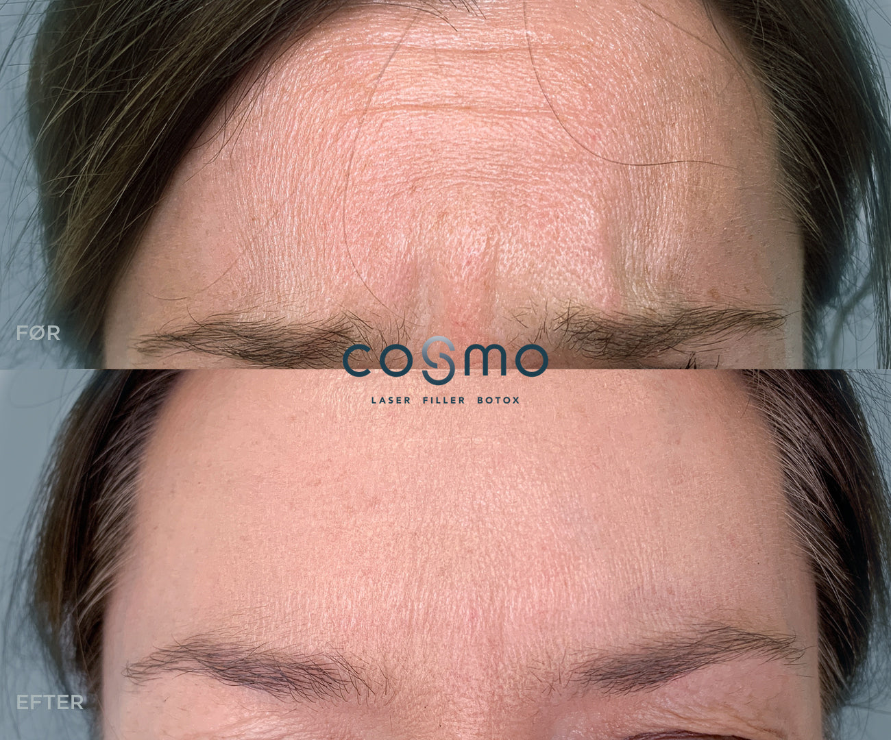 Før/efter billeder: Botoxbehandling af bekymringsrynker. Glattere pande hos Cosmo Laser. Før/efter billeder: Botoxbehandling af bekymringsrynker. Glattere pande hos Cosmo Laser.
