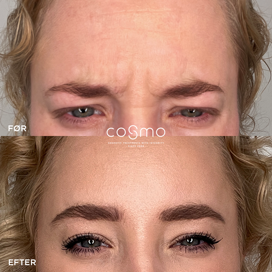 Før/efter billeder af botoxbehandling mod bekymringsrynker. Resultater fra Cosmo Laser. Før/efter billeder af botoxbehandling mod bekymringsrynker. Resultater fra Cosmo Laser.