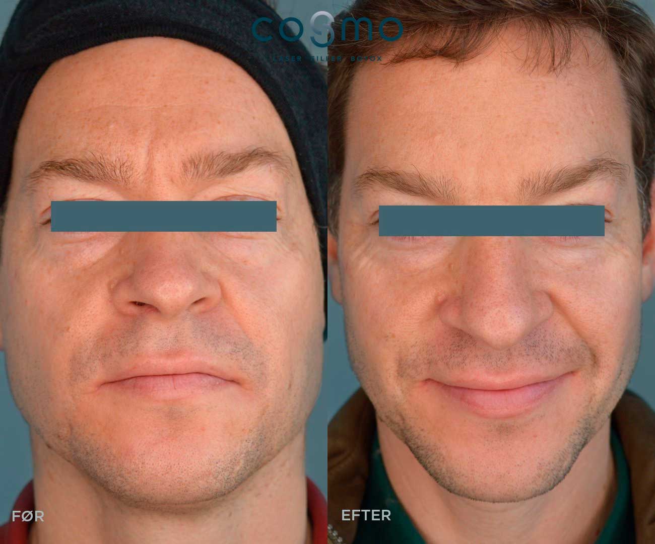 Før og efter botoxbehandling af bekymringsrynker. Før og efter botoxbehandling af bekymringsrynker.