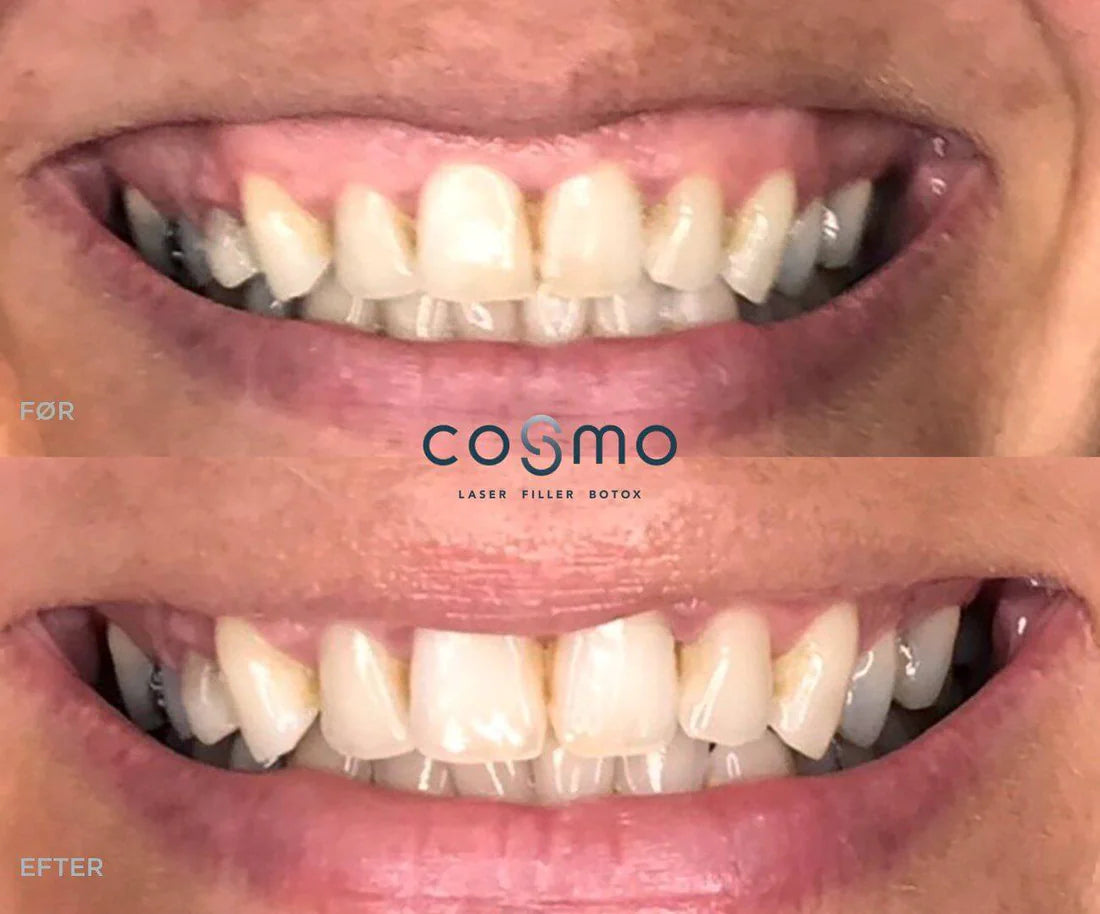 Før/efter billeder: Botox behandling mod gummy smile hos Cosmo Laser. Flotte resultater! Før/efter billeder: Botox behandling mod gummy smile hos Cosmo Laser. Flotte resultater!
