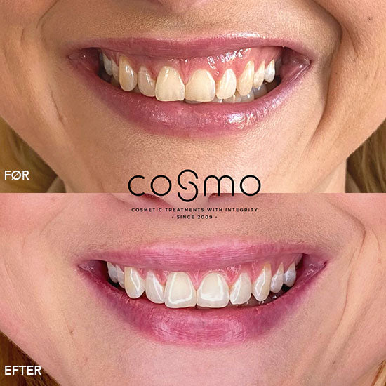 Før/efter billeder af botoxbehandling mod gummy smile. Få et smukt smil hos Cosmo Laser. Før/efter billeder af botoxbehandling mod gummy smile. Få et smukt smil hos Cosmo Laser.