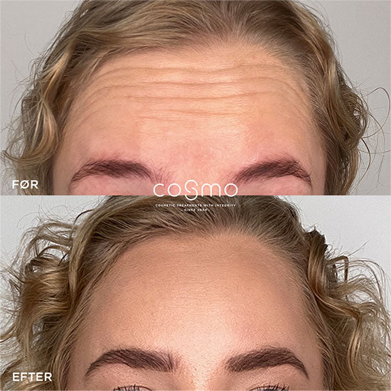 Før/efter billeder af botoxbehandling mod panderynker. Resultater fra Cosmo Laser. Før/efter billeder af botoxbehandling mod panderynker. Resultater fra Cosmo Laser.