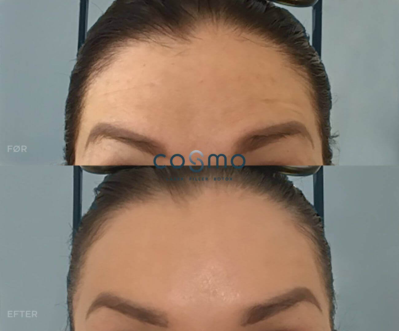 Før og efter botoxbehandling af panderynker.