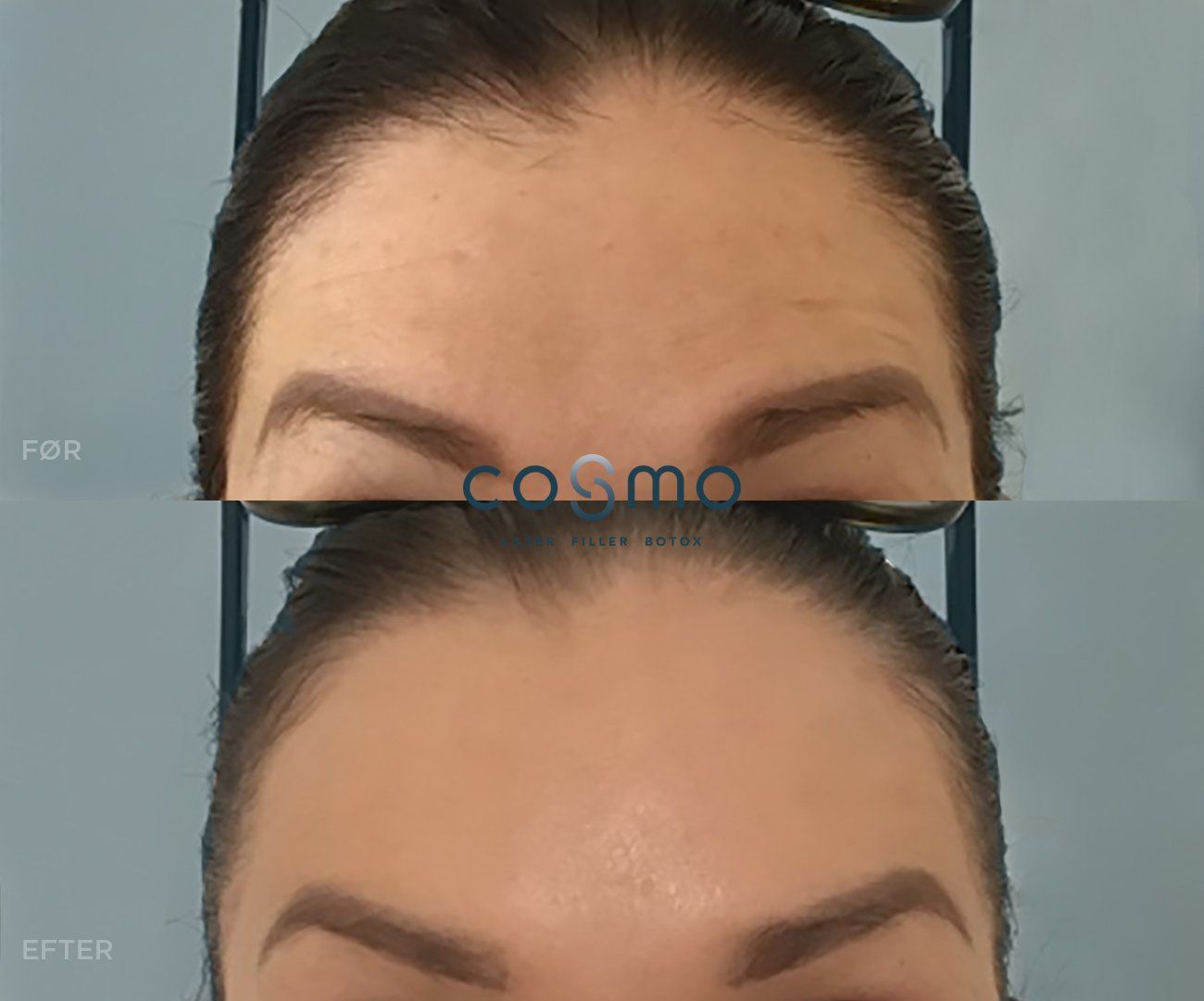 Før og efter botoxbehandling af panderynker. Før og efter botoxbehandling af panderynker.