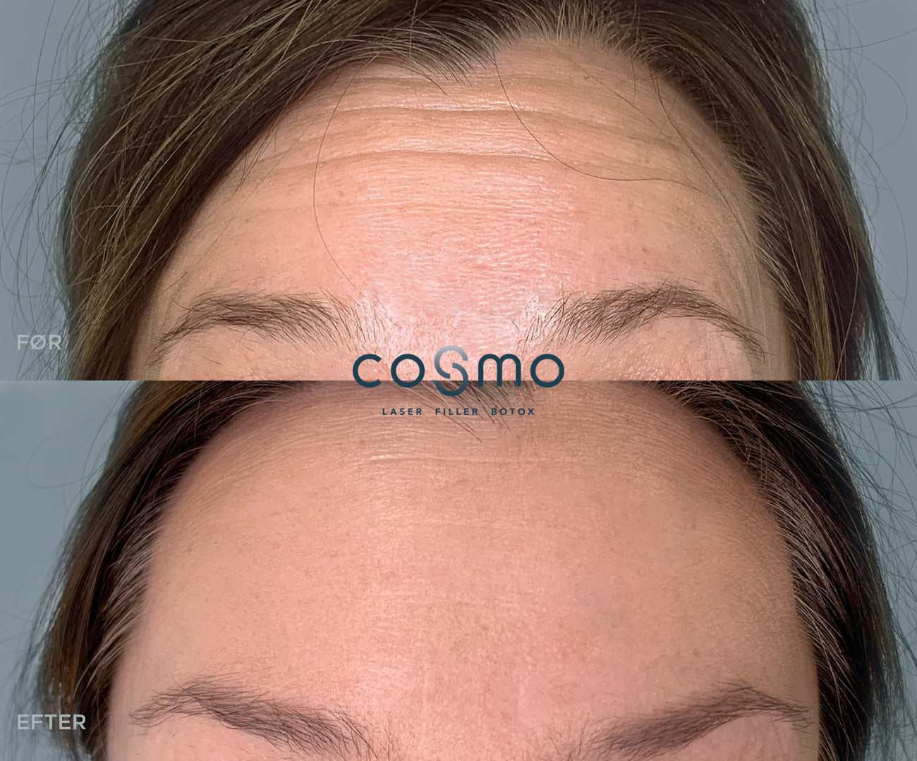 Før/efter billeder: Botoxbehandling mod panderynker hos Cosmo Laser. Flot resultat med glattere pande. Før/efter billeder: Botoxbehandling mod panderynker hos Cosmo Laser. Flot resultat med glattere pande.