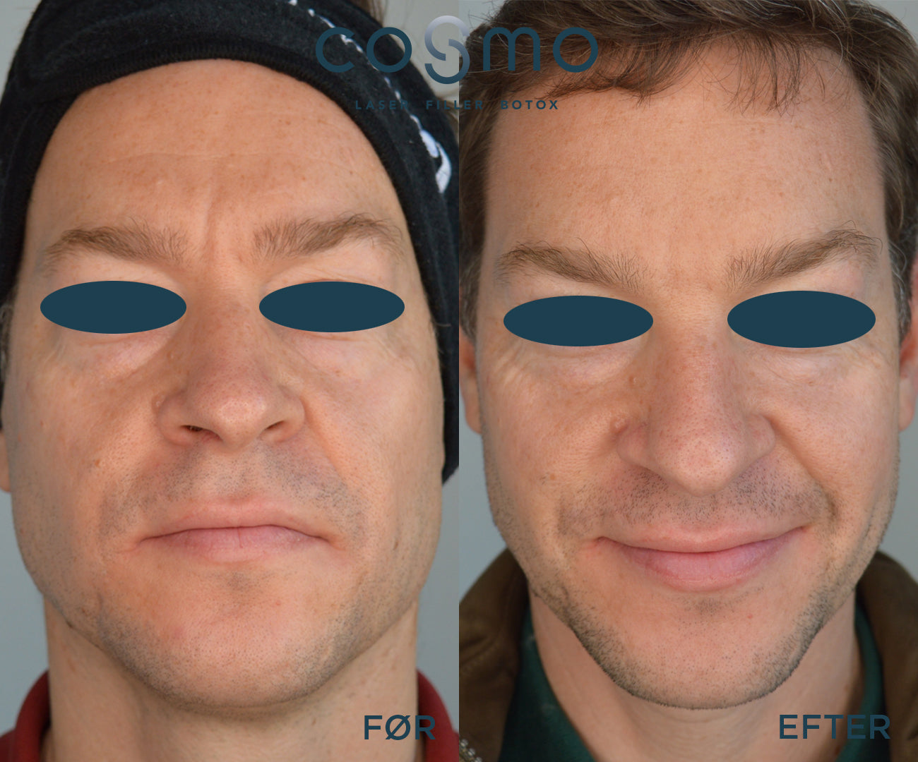 Før/efter billeder af botoxbehandling mod panderynker. Resultater fra Cosmo Laser. Før/efter billeder af botoxbehandling mod panderynker. Resultater fra Cosmo Laser.