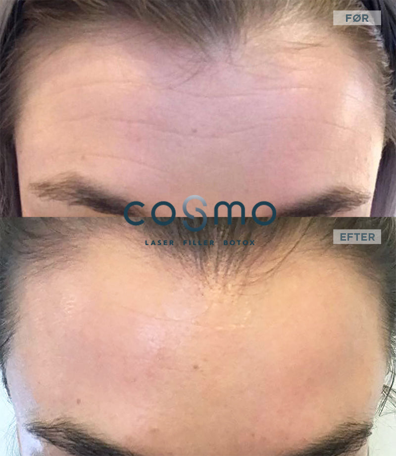 Før/efter billeder af panderynker behandlet med Botox hos Cosmo Laser. Før/efter billeder af panderynker behandlet med Botox hos Cosmo Laser.