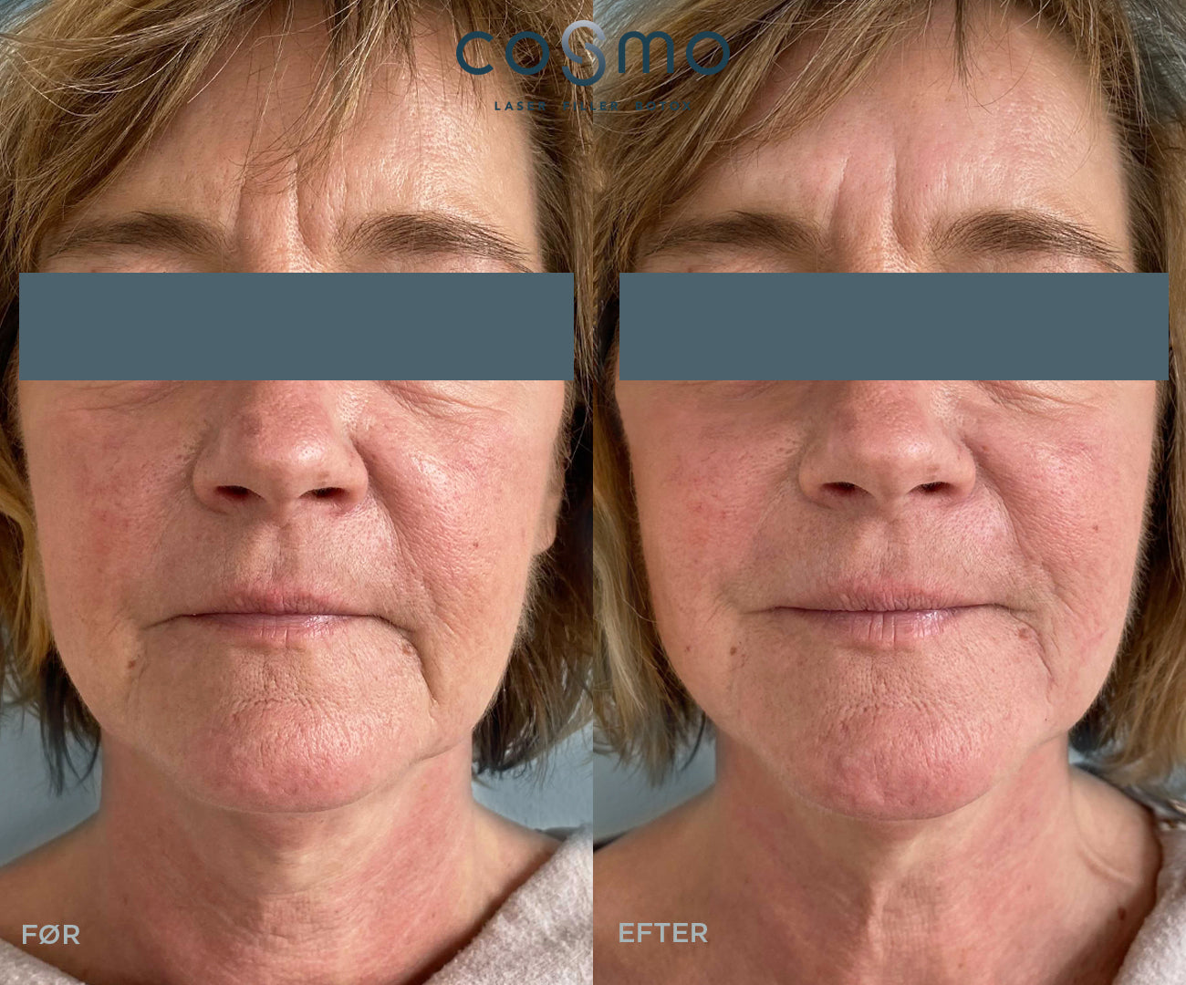 Før/efter billeder af botoxbehandling hos Cosmo Laser. Reducerer rynker og fine linjer. Før/efter billeder af botoxbehandling hos Cosmo Laser. Reducerer rynker og fine linjer.
