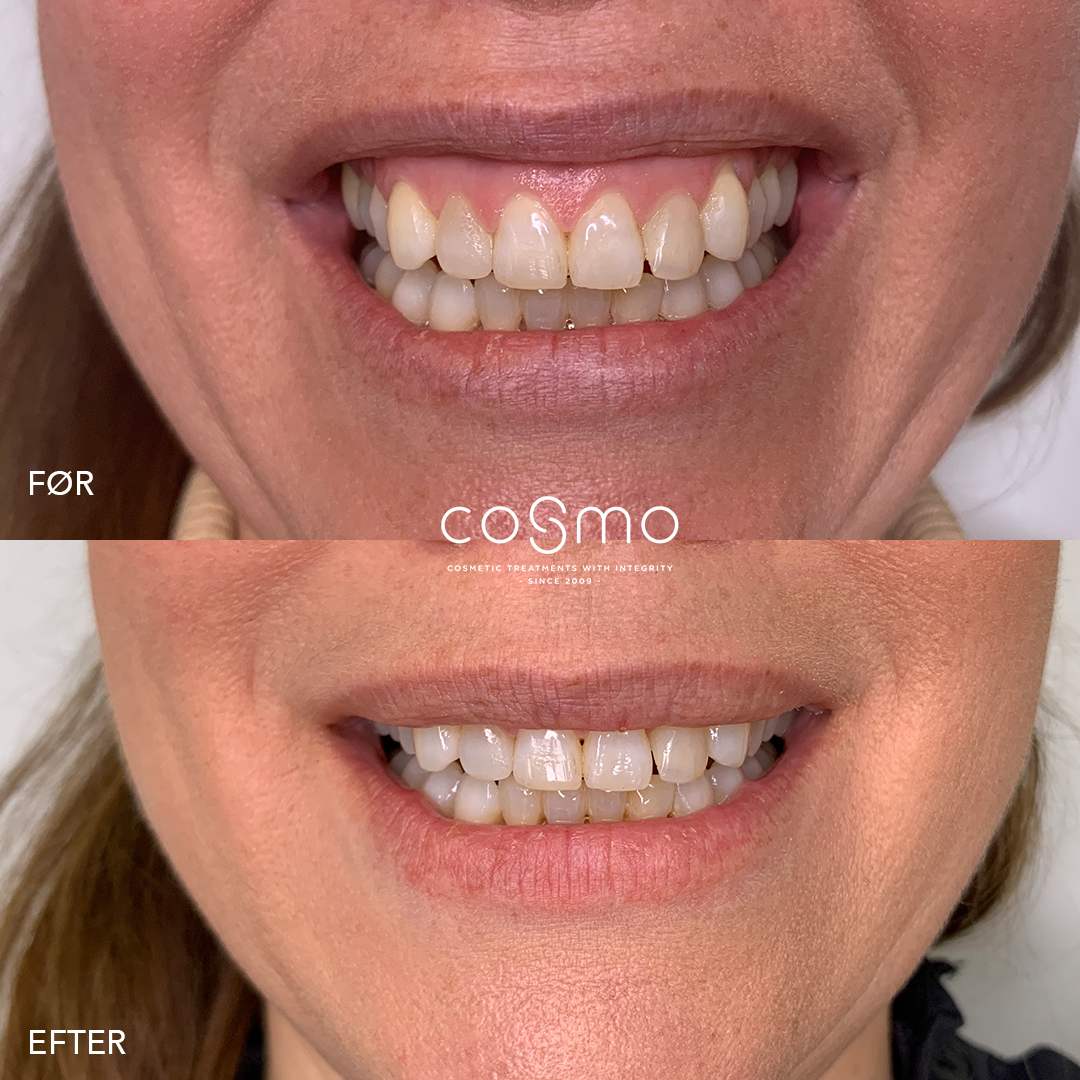 Før/efter billeder af botoxbehandling mod gummy smile. Få et smukt smil hos Cosmo Laser. Før/efter billeder af botoxbehandling mod gummy smile. Få et smukt smil hos Cosmo Laser.