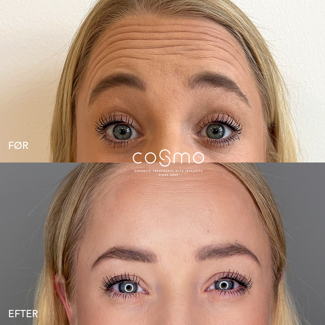 Før/efter billeder: Botoxbehandling af panderynker hos Cosmo Laser. Glattere pande, færre rynker. Før/efter billeder: Botoxbehandling af panderynker hos Cosmo Laser. Glattere pande, færre rynker.