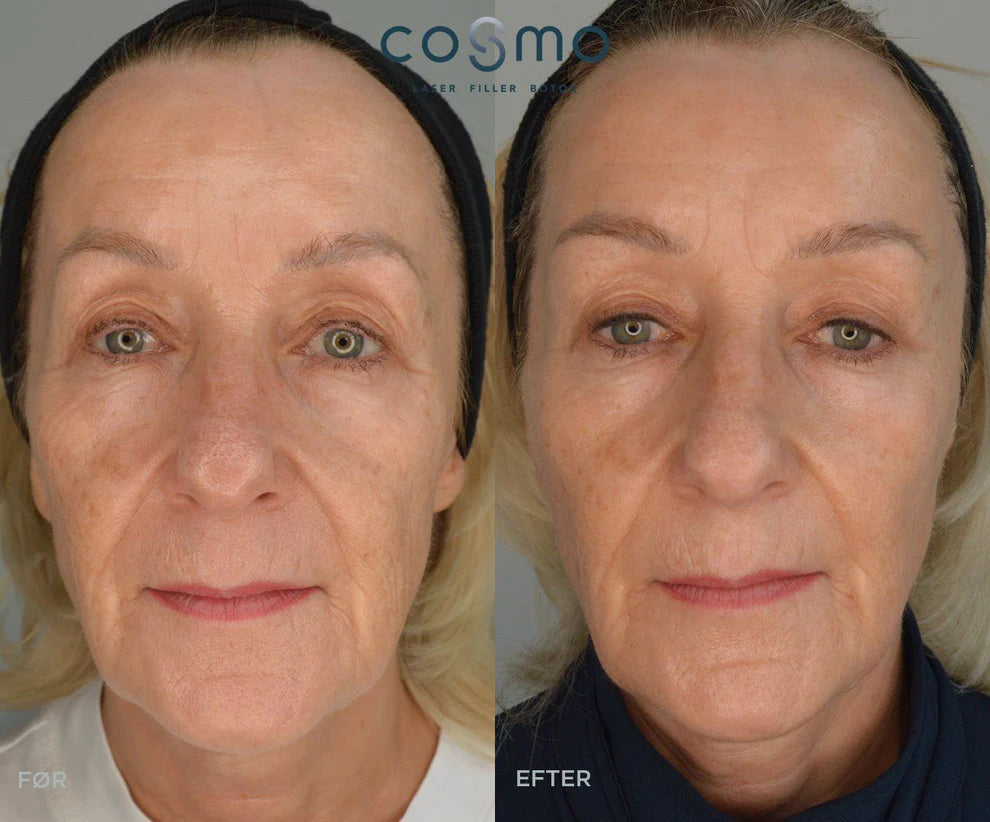 Før/efter: Hudforyngelse med filler hos Cosmo Laser. Færre rynker og mere fylde. Før/efter: Hudforyngelse med filler hos Cosmo Laser. Færre rynker og mere fylde.