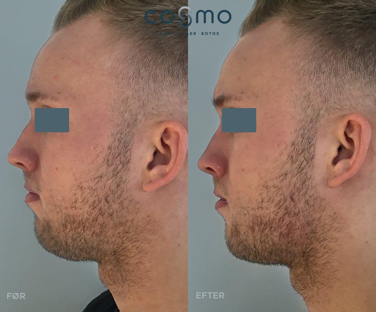 Før og efter fillerbehandling af kæbelinje. Før og efter fillerbehandling af kæbelinje.