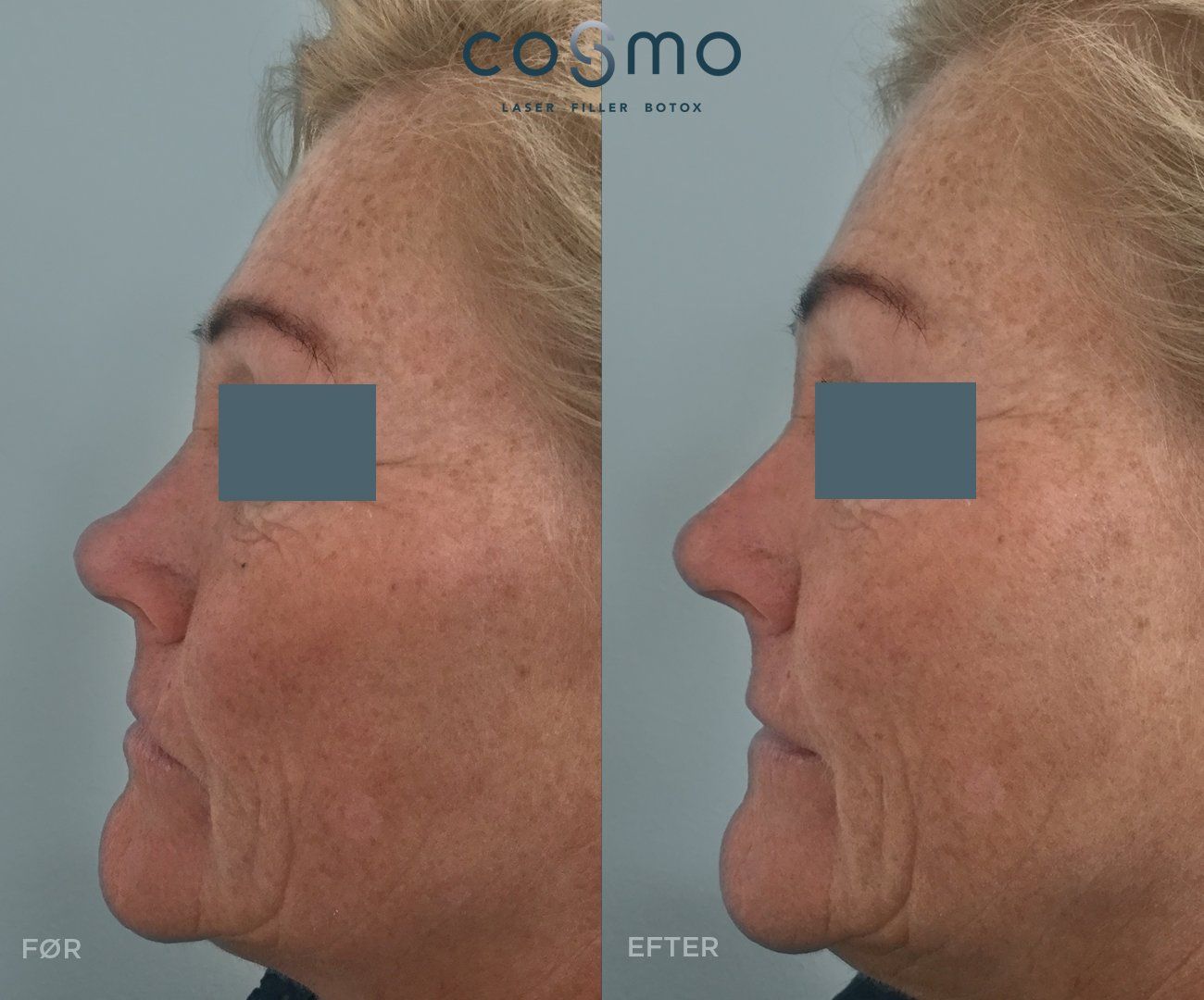 Før og efter fillerbehandling af næseryg. Før og efter fillerbehandling af næseryg.