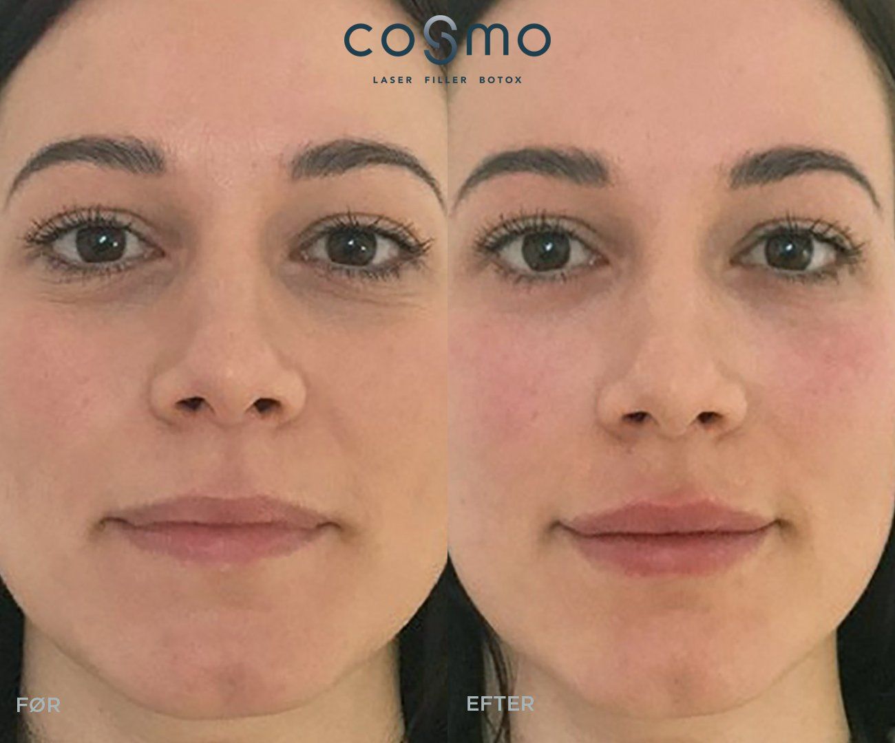 Før og efter fillerbehandling af tåretruget. Før og efter fillerbehandling af tåretruget.