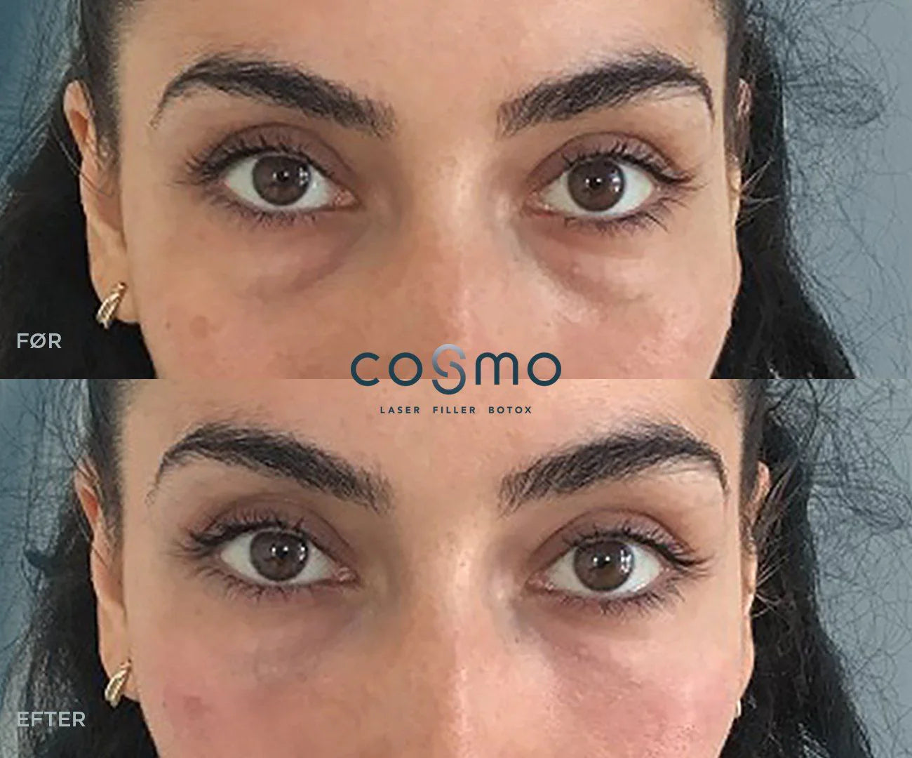 Før/efter fillerbehandling af tåretrug hos Cosmo Laser. Fyldigere kinder og et mere frisk udseende. Før/efter fillerbehandling af tåretrug hos Cosmo Laser. Fyldigere kinder og et mere frisk udseende.