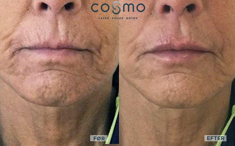 Før og efter fillerbehandling af rygerynker og læber.