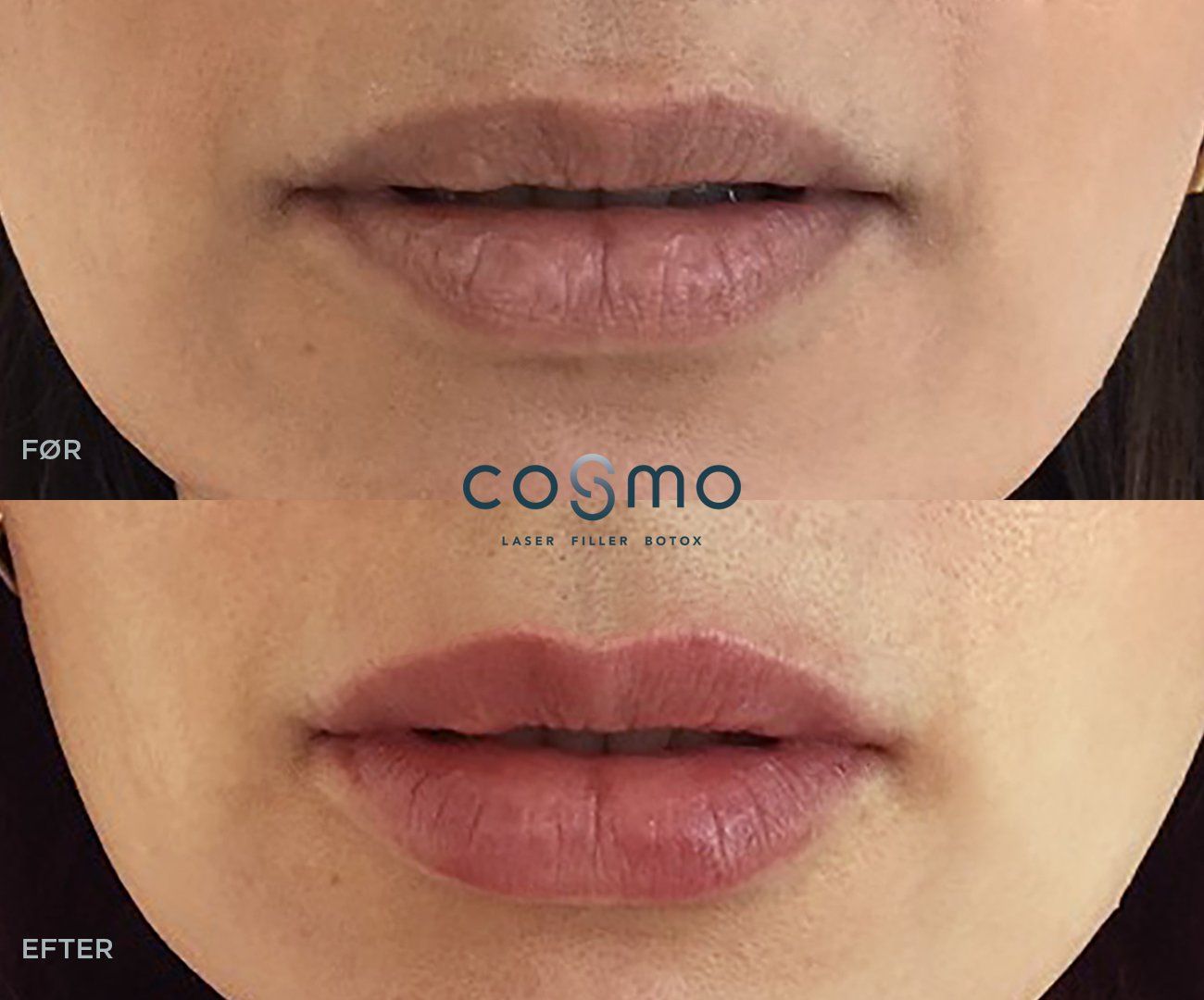 Før og efter læbefiller behandling. Før og efter læbefiller behandling.