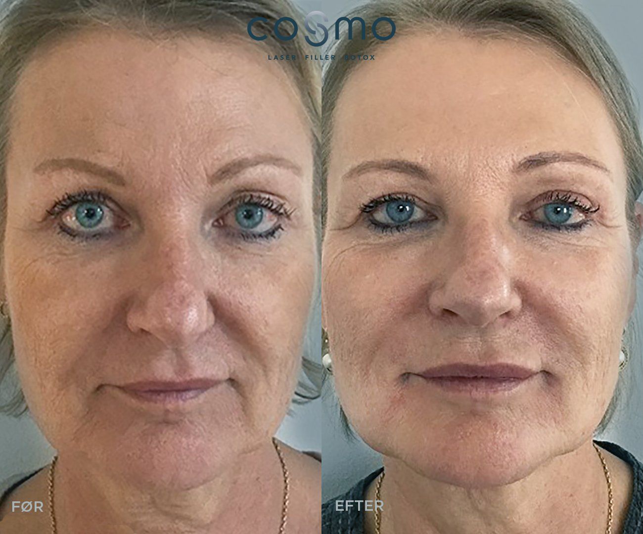 Før og efter fillerbehandling af nasolabiale folder. Før og efter fillerbehandling af nasolabiale folder.