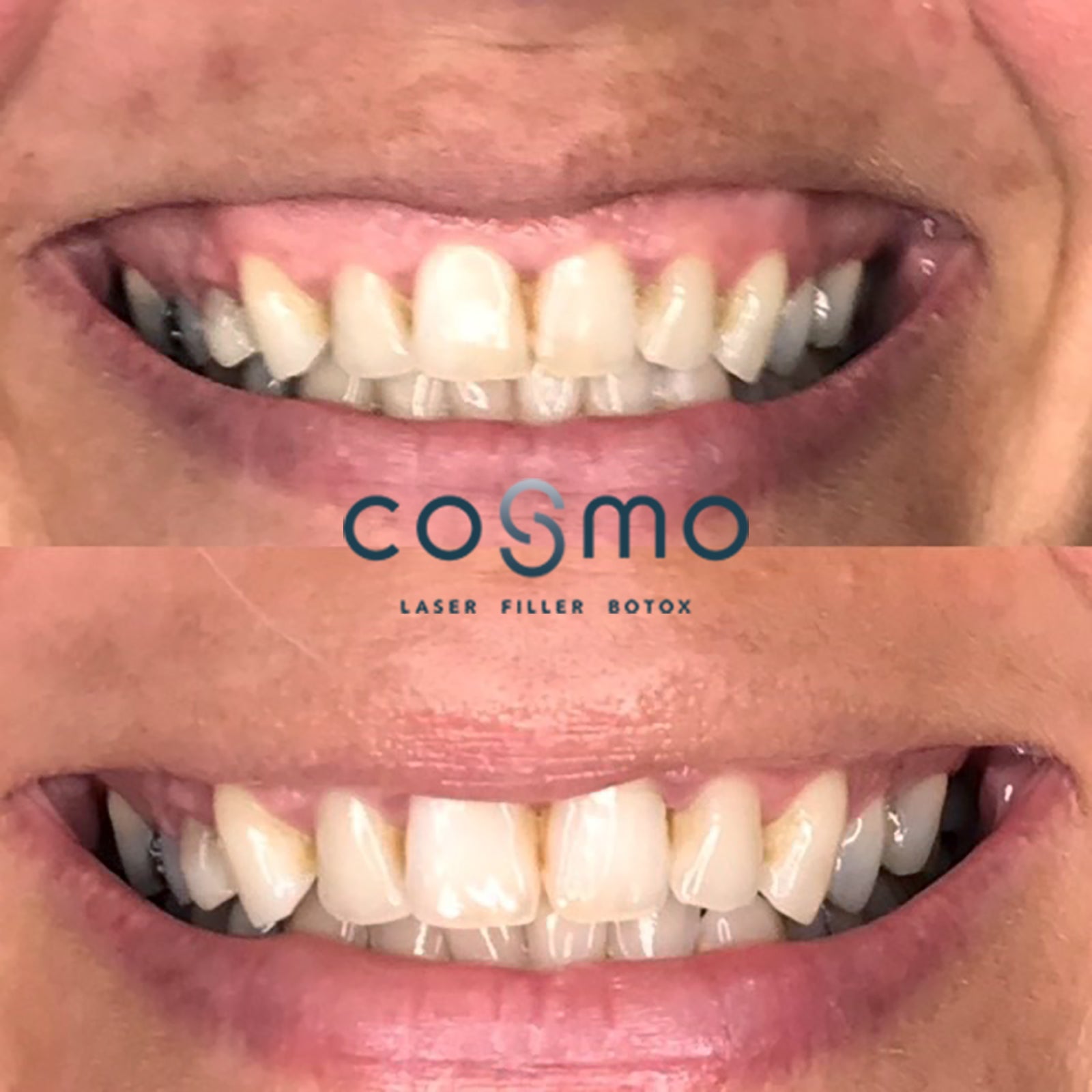 Før/efter billeder: Botox behandling mod gummy smile hos Cosmo Laser. Før/efter billeder: Botox behandling mod gummy smile hos Cosmo Laser.