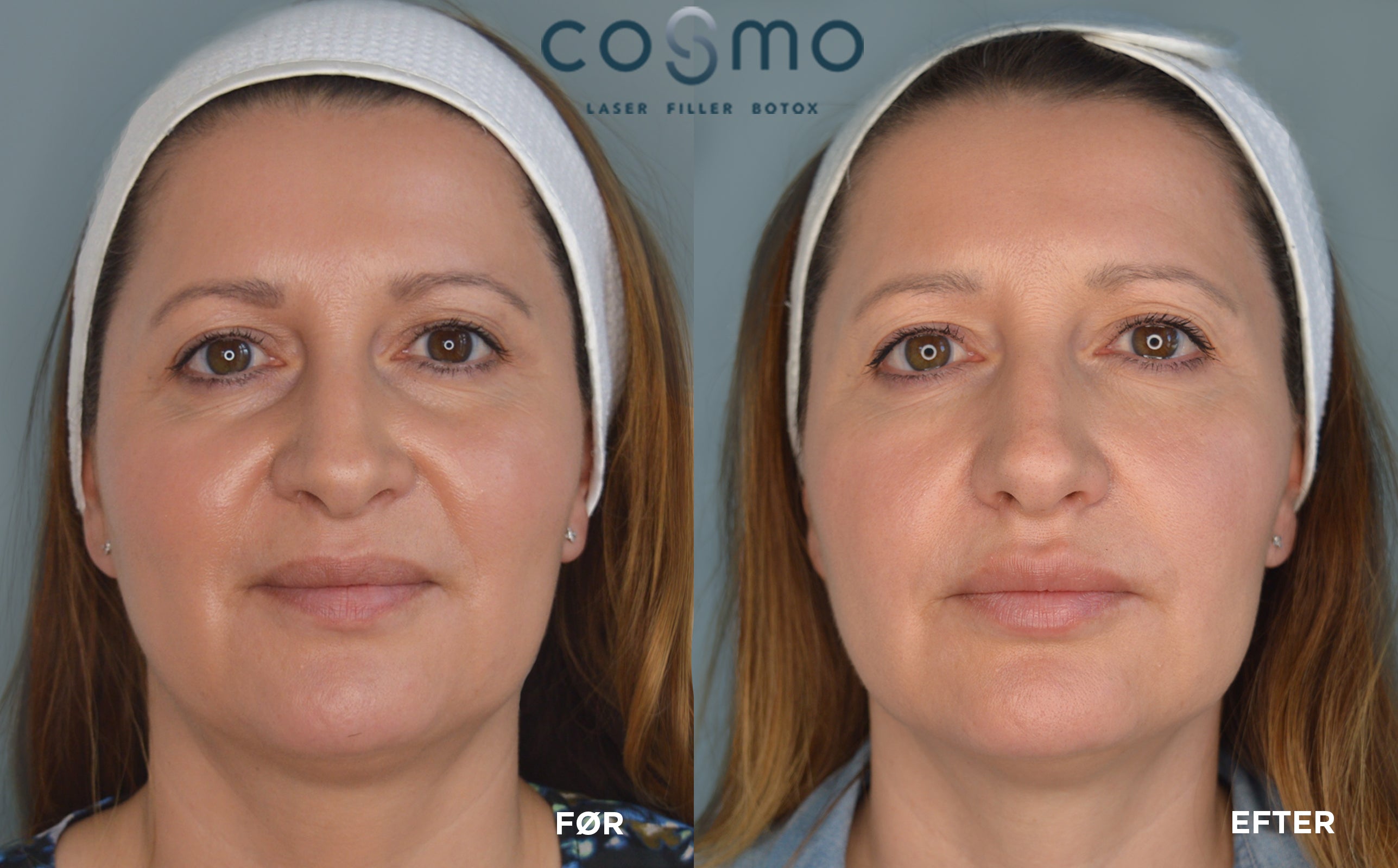 Før/efterbillede af laserbehandling hos Cosmo Laser. Synligt forbedret hudtone og færre rynker. Før/efterbillede af laserbehandling hos Cosmo Laser. Synligt forbedret hudtone og færre rynker.