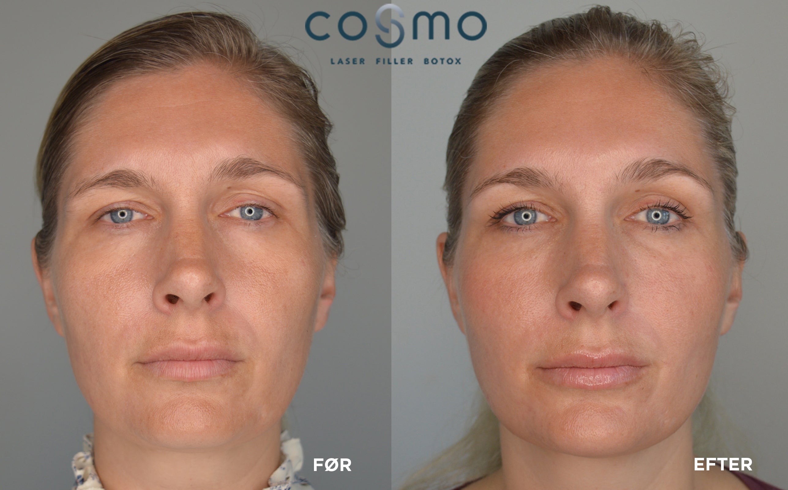 Før/efter laserbehandling hos Cosmo Laser. Sarahs makeover med botox og filler. Før/efter laserbehandling hos Cosmo Laser. Sarahs makeover med botox og filler.