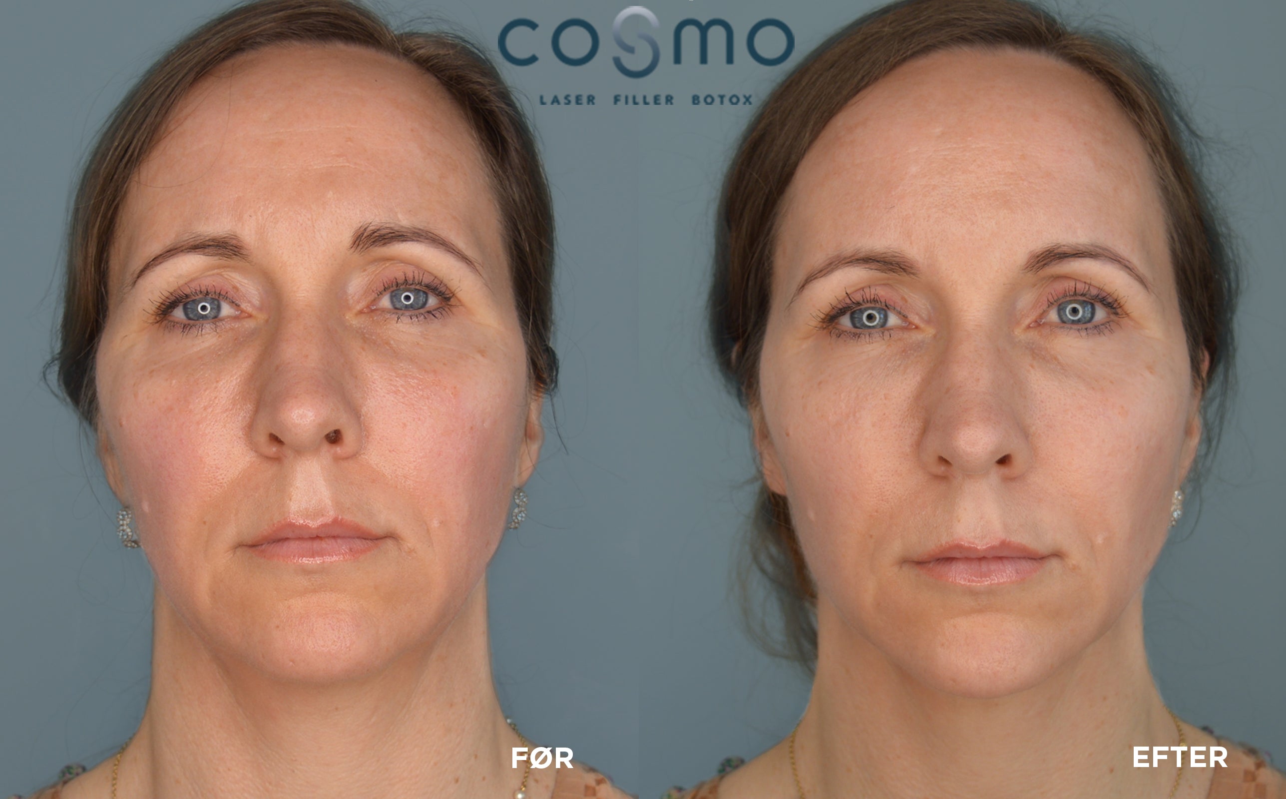 Før & efter fillerbehandling hos Cosmo Laser. Synligt forbedret hudtone og færre rynker. Før & efter fillerbehandling hos Cosmo Laser. Synligt forbedret hudtone og færre rynker.