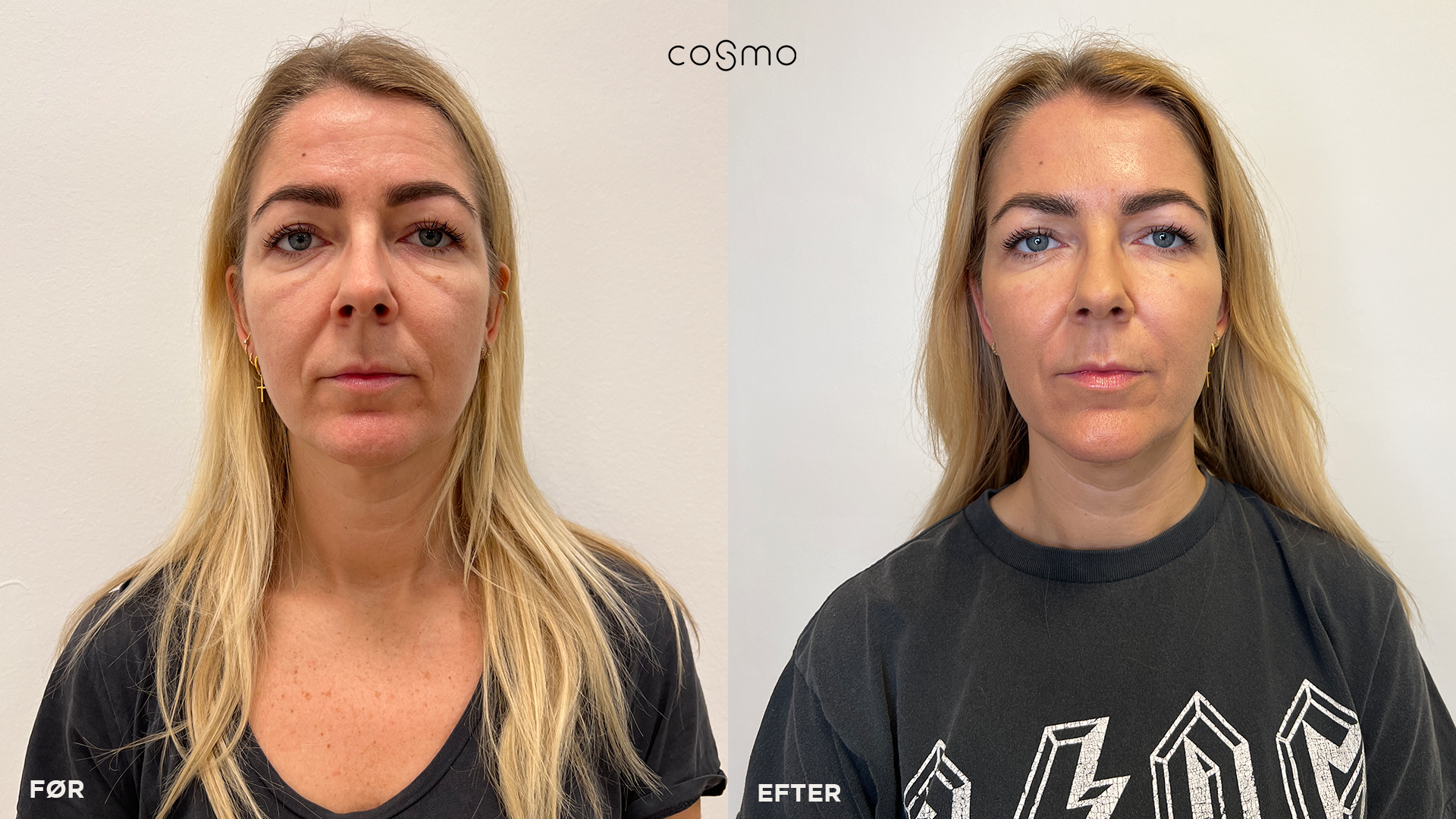 Før/efter-billede af Julie: Frax, IPL, Profhilo, Botox & filler hos Cosmo Laser. Før/efter-billede af Julie: Frax, IPL, Profhilo, Botox & filler hos Cosmo Laser.