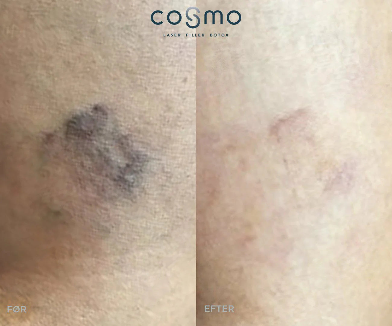 Før/efter-billede af karsprængninger på ben behandlet hos Cosmo Laser. Før/efter-billede af karsprængninger på ben behandlet hos Cosmo Laser.