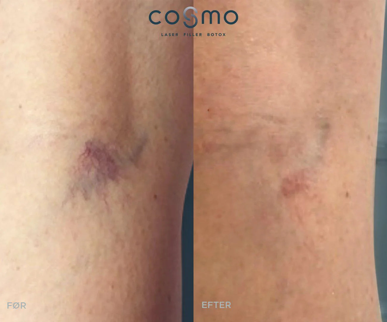 Før/efter billeder af karsprængninger på ben behandlet hos Cosmo Laser. Før/efter billeder af karsprængninger på ben behandlet hos Cosmo Laser.