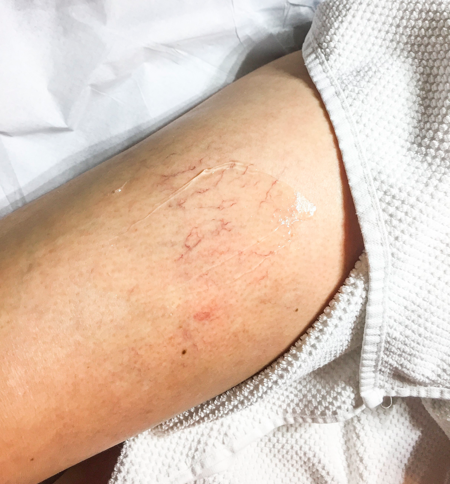 Fjernelse af karsprængninger med laserbehandling hos Cosmo Laser.