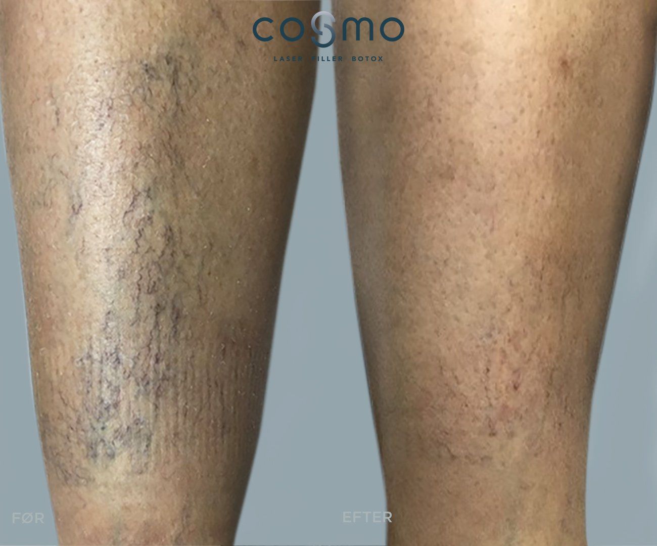 Før og efter karsprængninger på underben. Før og efter karsprængninger på underben.