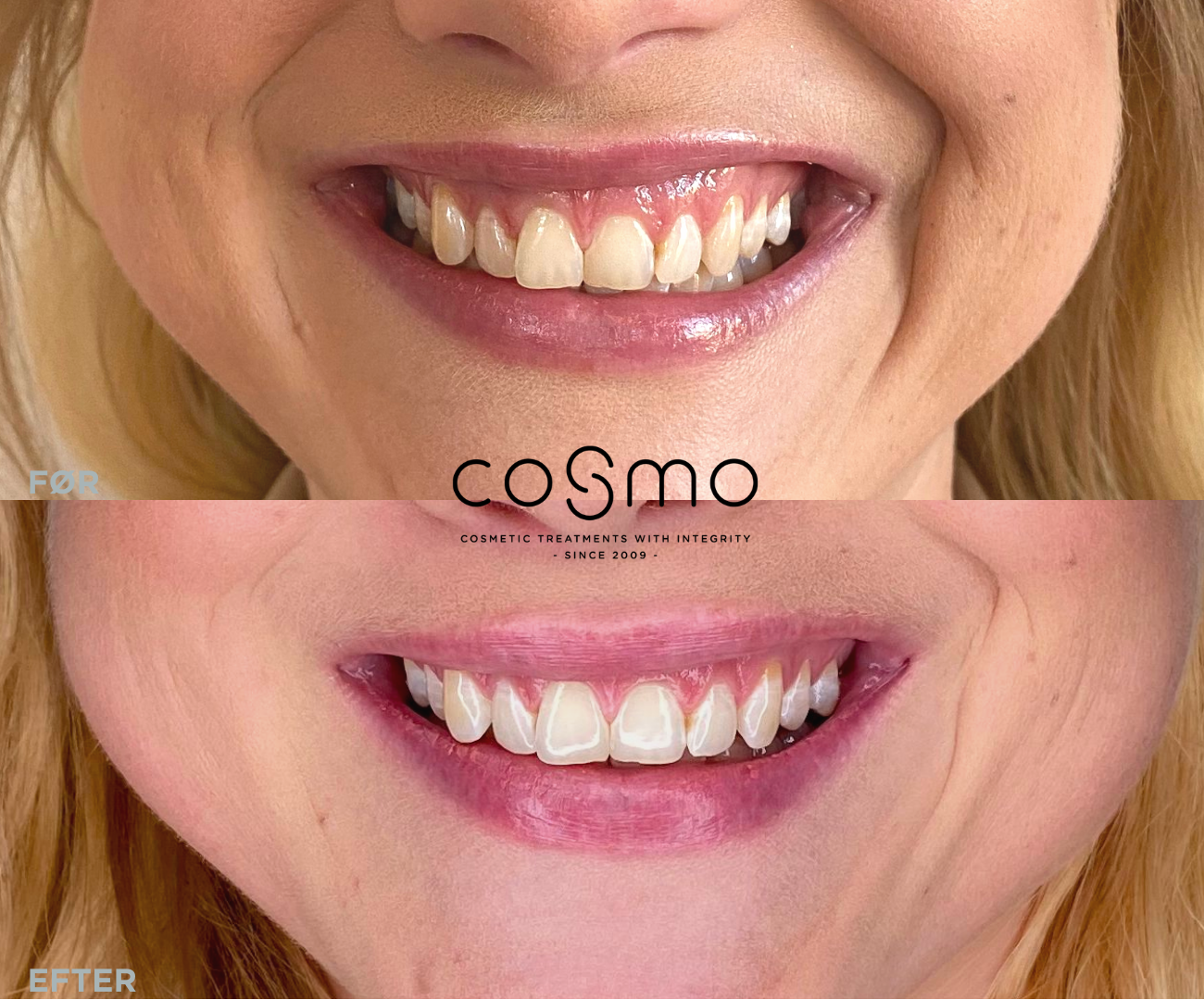 Før/efter billeder: Botox behandling mod gummy smile hos Cosmo Laser. Før/efter billeder: Botox behandling mod gummy smile hos Cosmo Laser.