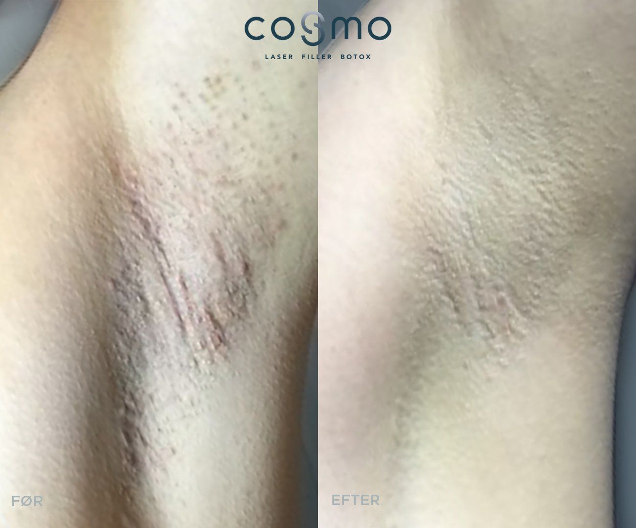 Før/efter laserbehandling af mørke armhuler. Resultater fra Cosmo Laser.