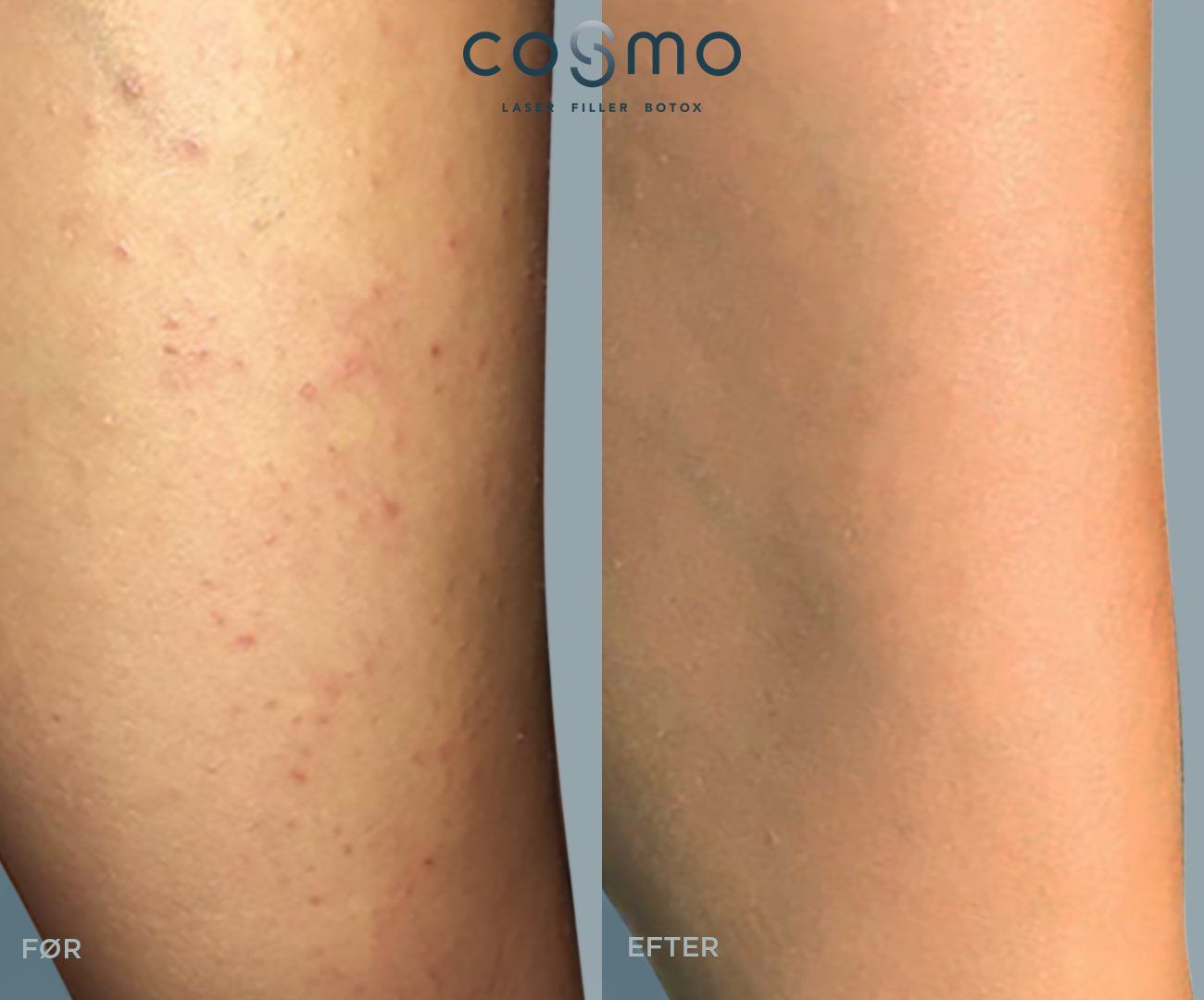 Før/efter laserbehandling af karsprængninger på ben. Effektiv behandling hos Cosmo Laser.