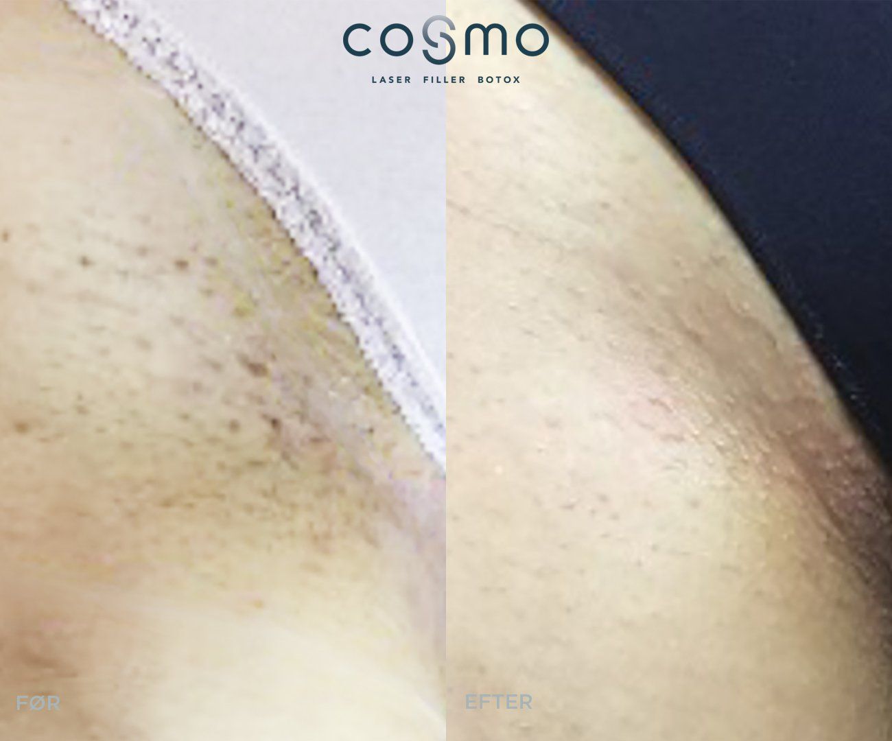 Før/efter laserbehandling af bikinilinje. Færre mørke hår. Resultater fra Cosmo Laser.