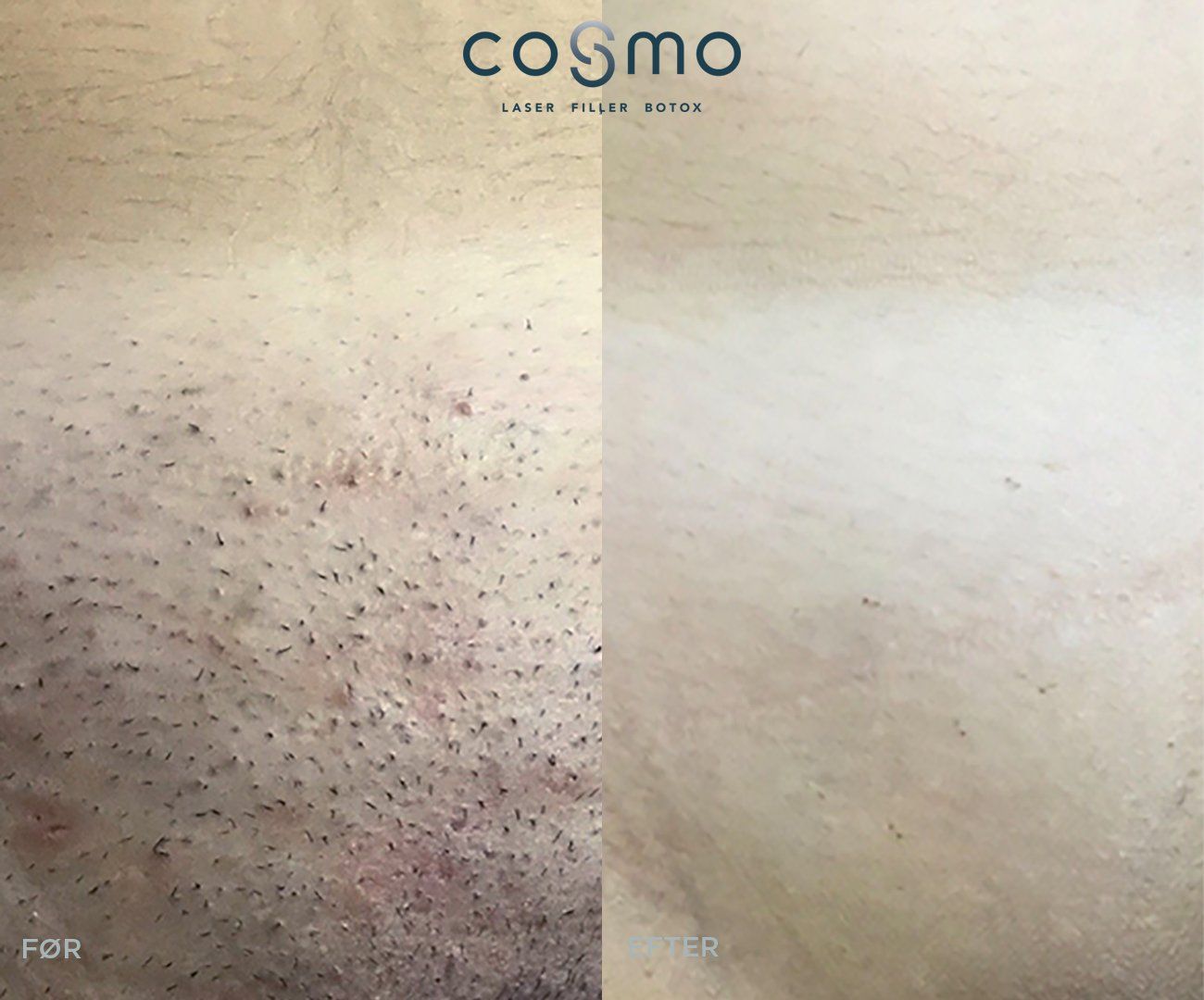 Før/efter laserbehandling af intimområde hos Cosmo Laser. Hårfjerning med effektivt og skånsomt resultat.