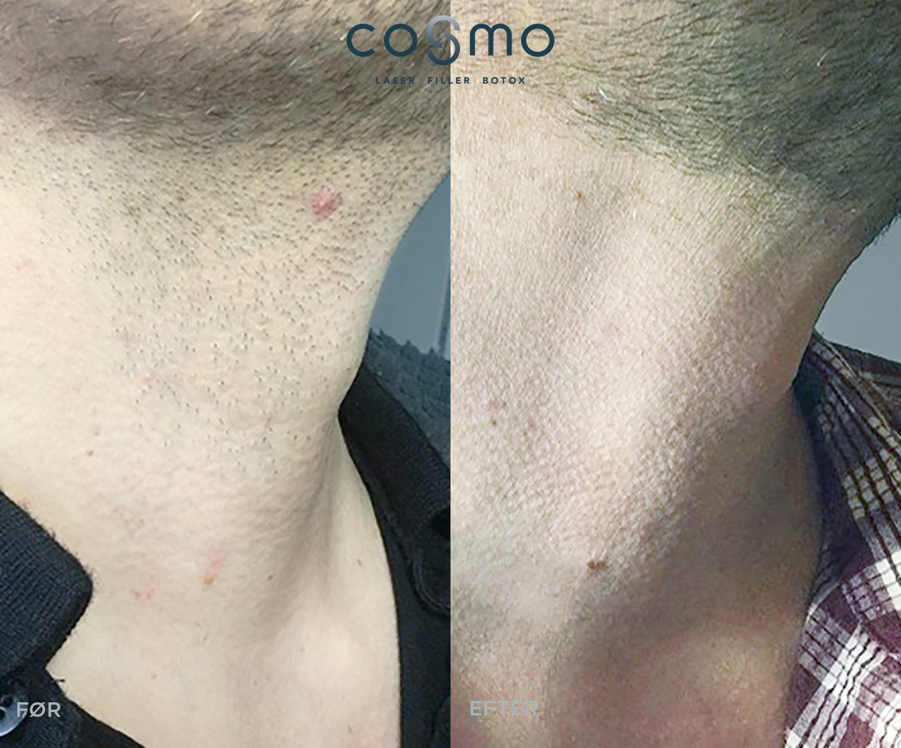 Før/efter laserbehandling af hals hos Cosmo Laser. Synligt forbedret hudtone og struktur.
