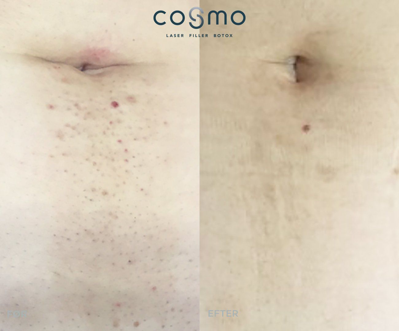 Før/efter-billede af mavebehandling. Før/efter-billede af mavebehandling.