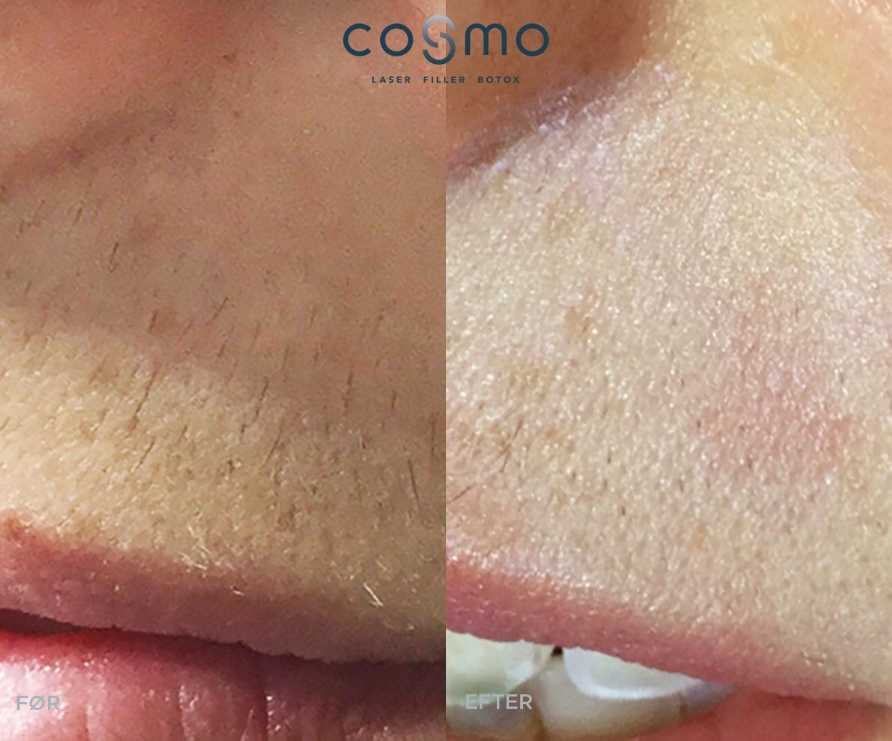 Før-og-efterbillede af hårfjerning over læben. Før-og-efterbillede af hårfjerning over læben.