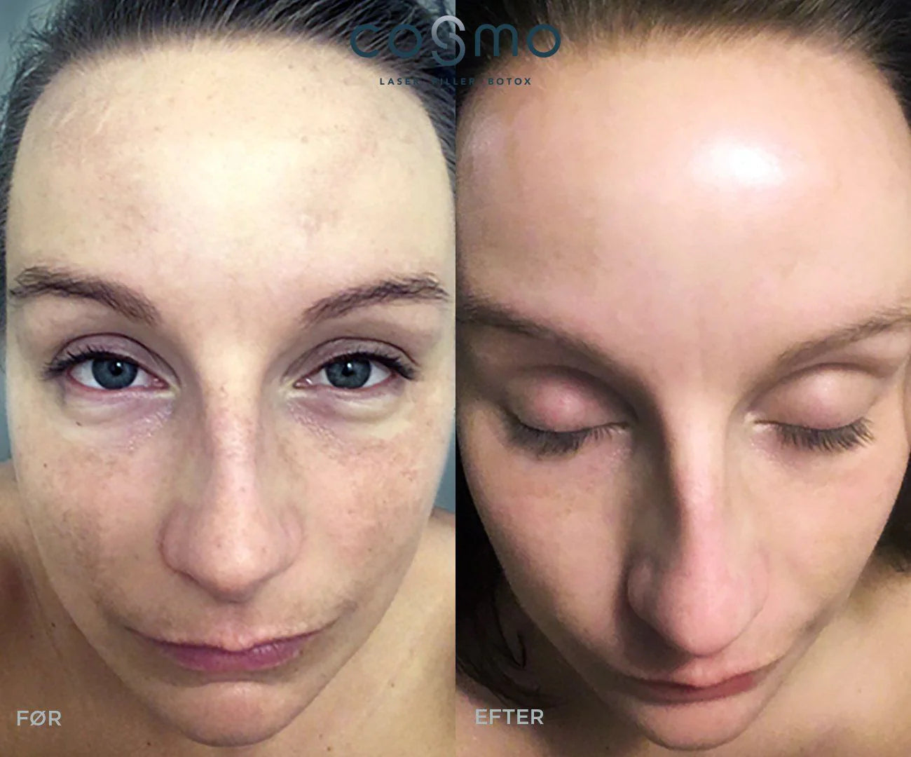 Før/efter laserbehandling af pigmentpletter i ansigtet. Resultater fra Cosmo Laser. Før/efter laserbehandling af pigmentpletter i ansigtet. Resultater fra Cosmo Laser.